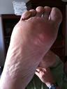 Blisters