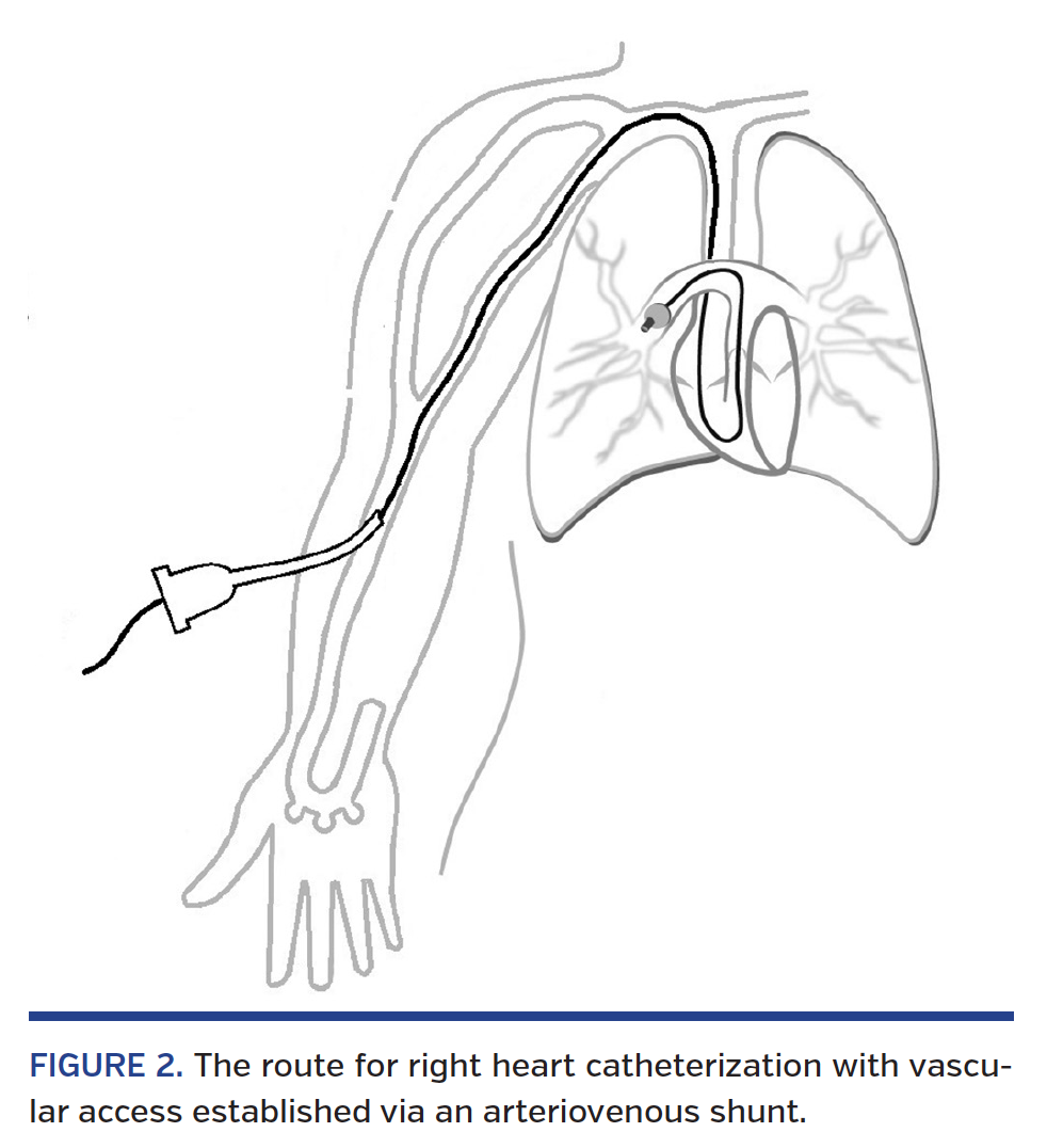 Right Heart Catheterization via Dialysis Arteriovenous Shunts in End