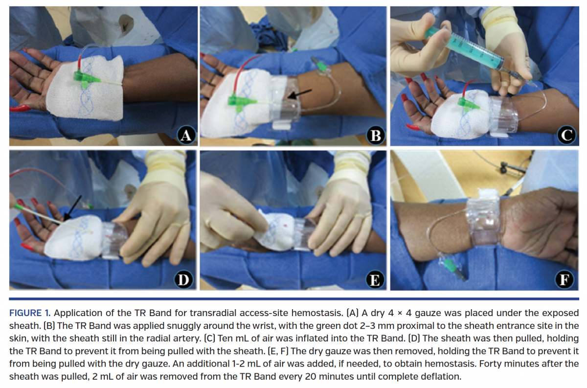 Comparison of Hemostasis Times With a KaolinBased Hemostatic Pad