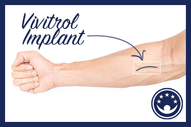 Is the Vivitrol Implant Effective?