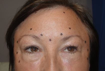 Botox%20points%20marked