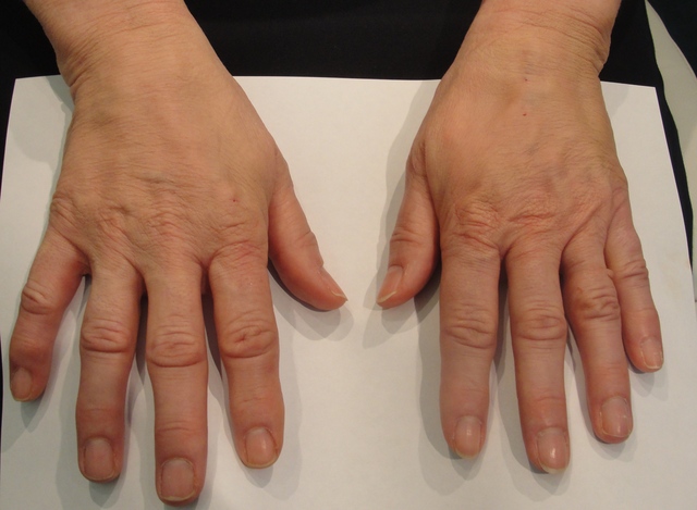 After%20treatment%20with%20radiesse%20(clipped)