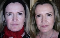 Cosmetic Acupuncture Before and After