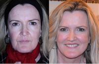 Reverse-Aging Facial
