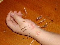 Scar Removal Acupuncture