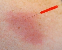 Acupuncture's Painkilling Secret Revealed: it's all in the Twist Action