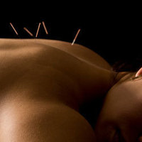 Acupuncture: What Is it and Why Does it Work?