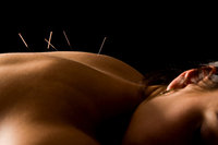 Acupuncture - 