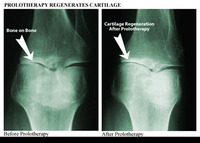 Prolotherapy - Joint Rejuvenation