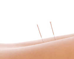 Acupuncture
