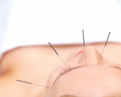 Acupuncture