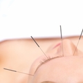 Acupuncture