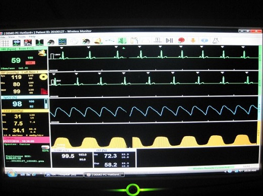 Anesthesia Monitor