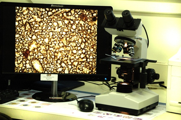 Fat Drops in a Fecal Sample