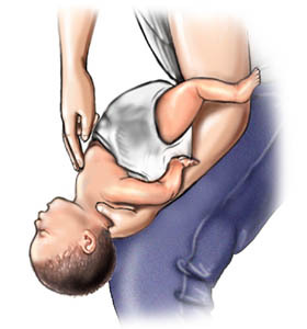 first aid for choking