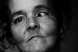 Strabismus