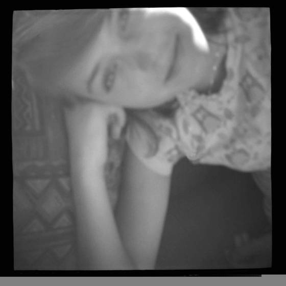 Emily_s_scar