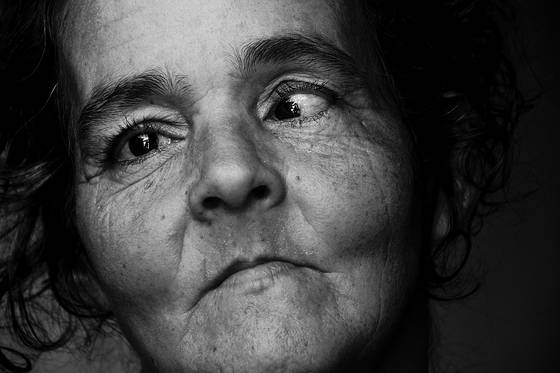 Strabismus