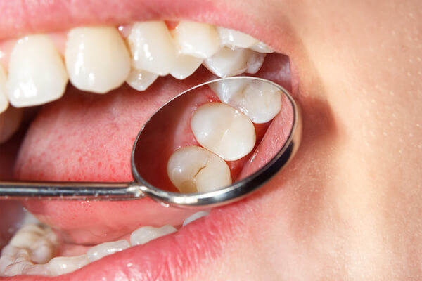 dental sealants