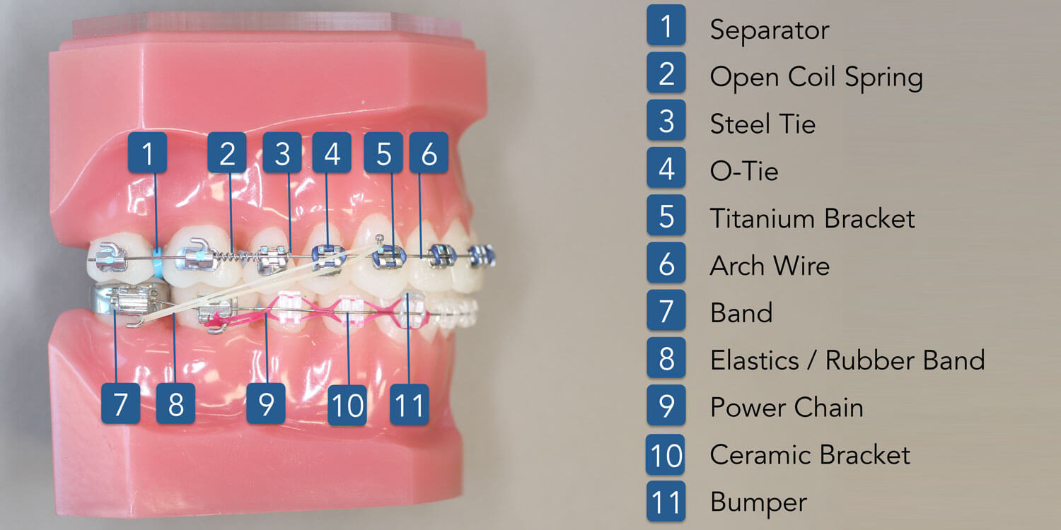 SOKnowyourBraces01 Strickland Orthodontics