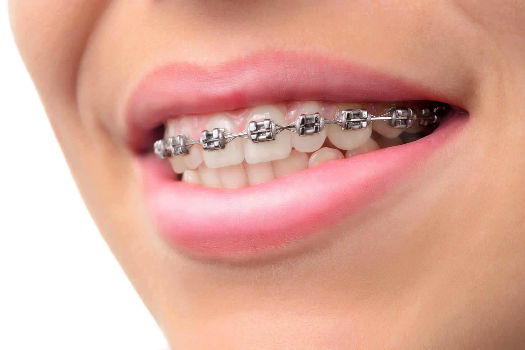 Closeup teeth with braces Strickland Orthodontics