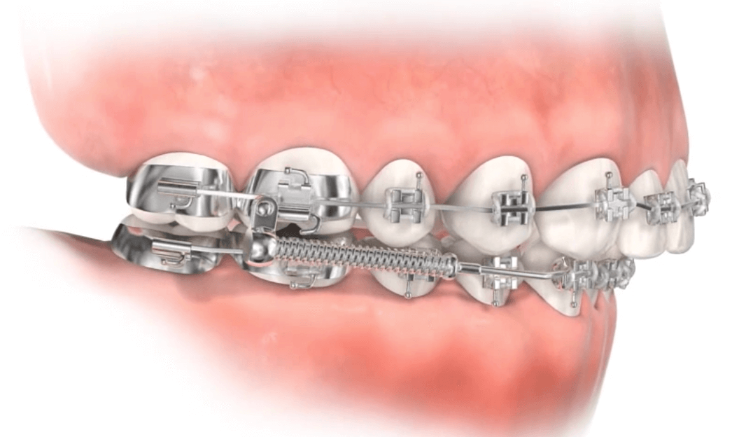 Auxiliary Appliances Treatments Strickland Orthodontics