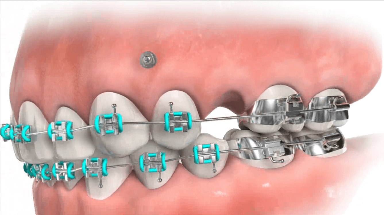 Auxiliary Appliances Treatments Strickland Orthodontics