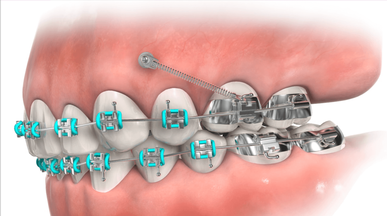 Auxiliary Appliances Treatments Strickland Orthodontics