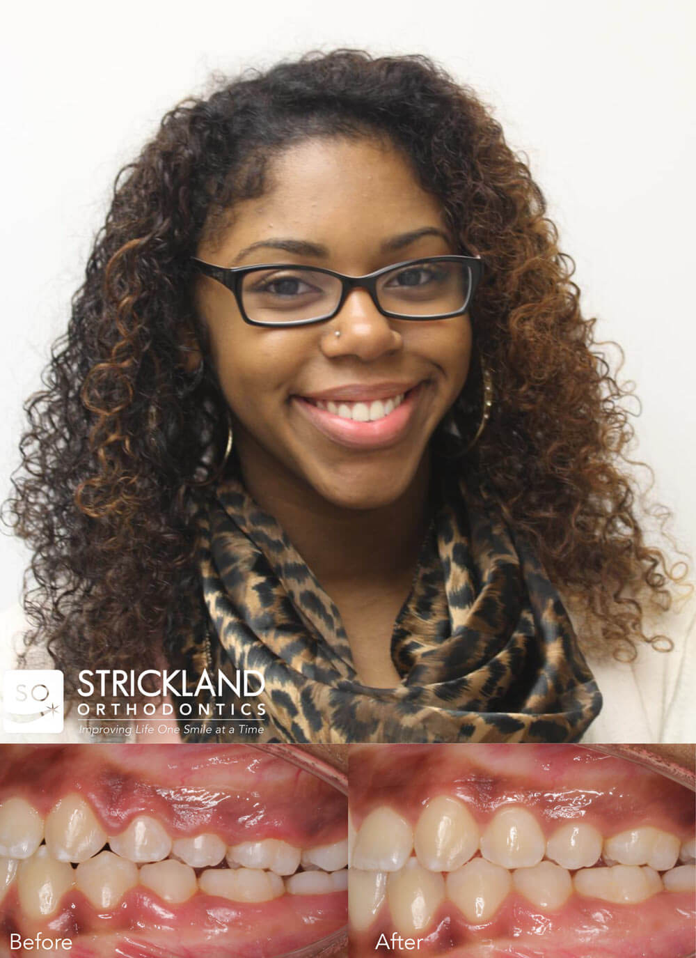 Soft Tissue Laser Treatments Strickland Orthodontics