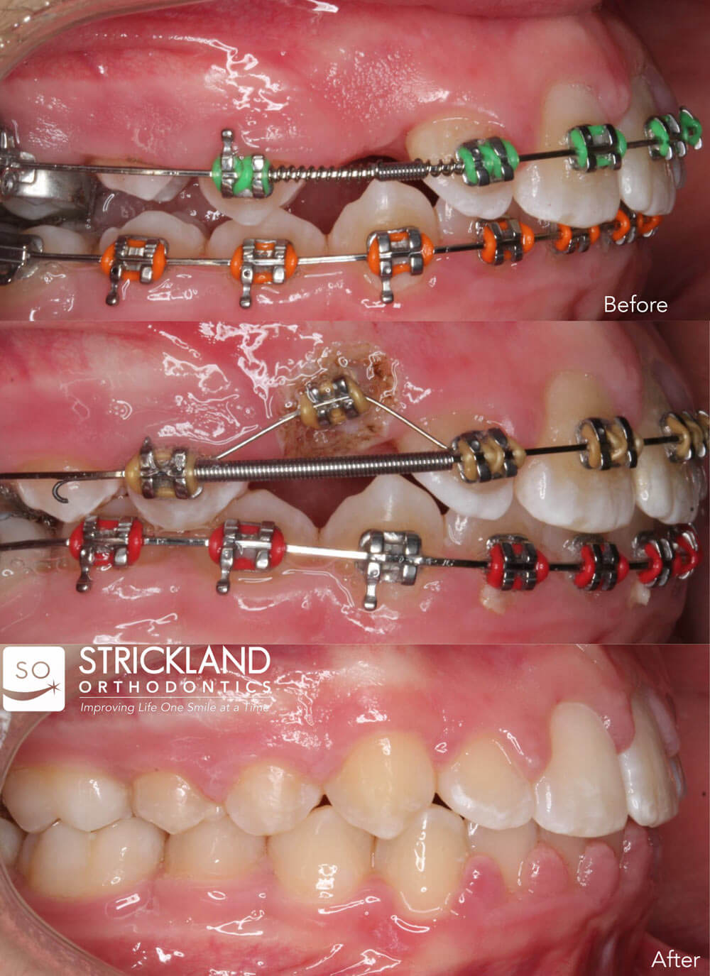 Soft Tissue Laser Treatments Strickland Orthodontics