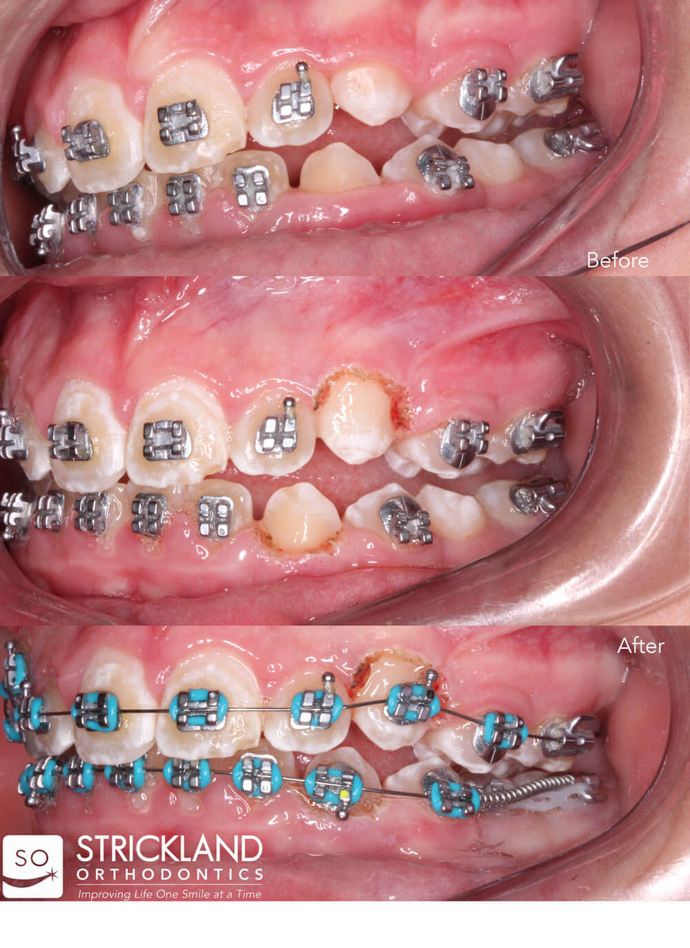 Soft Tissue Laser Treatments Strickland Orthodontics