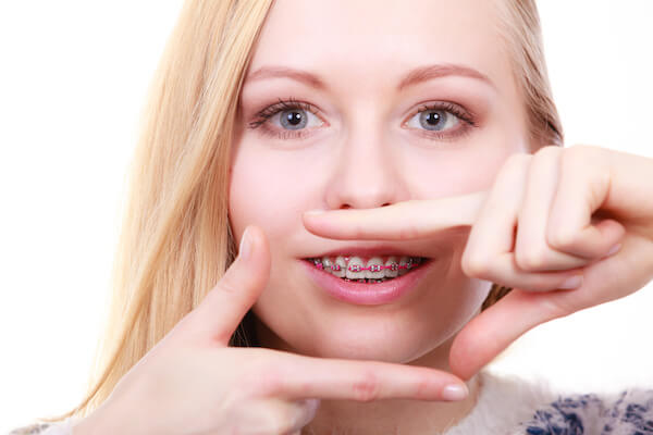 braces