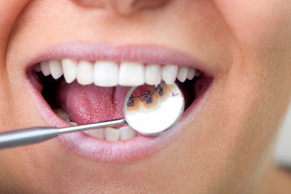 how do you clean lingual braces valderrama orthodontics lingual braces