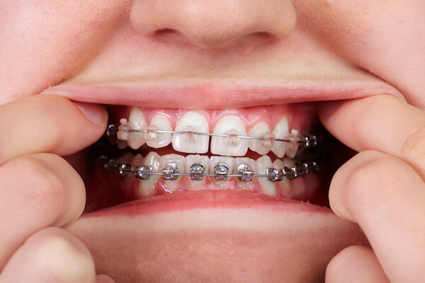 braces myths