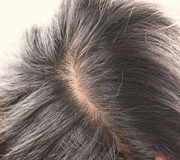 How to Treat Hair Loss by Strengthening Your Kidneys Healthfully