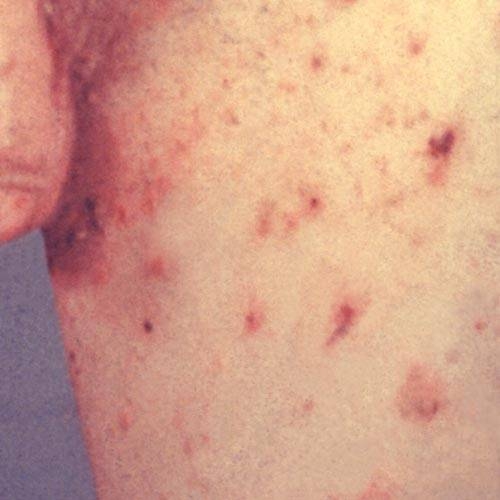 How to Treat Scabies With Tea Tree Oil Healthfully