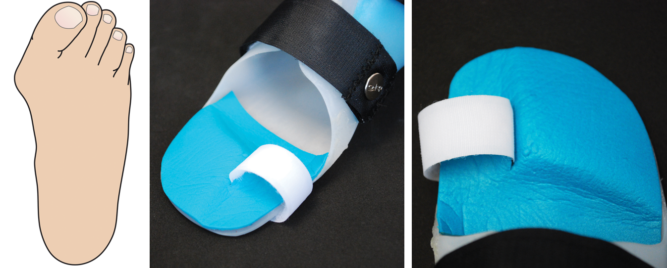 Pronation Control Cascade Dafo