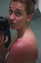 sunburn