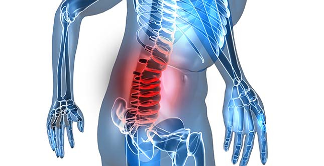 Artrose Rug : Symptomen, Behandeling & Oefeningen