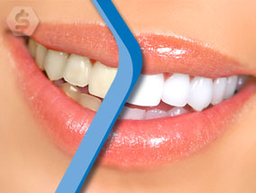 Ver la oferta: BLANQUEMIENTO DENTAL por LASER de ultima generación, que reduce hasta 6 tonos en sólo una hora con la mejor calidad. En sucursal Centro y Nordelta.