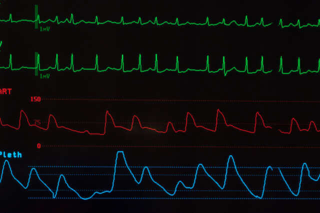Should Your Organization Add a TAVR Program?