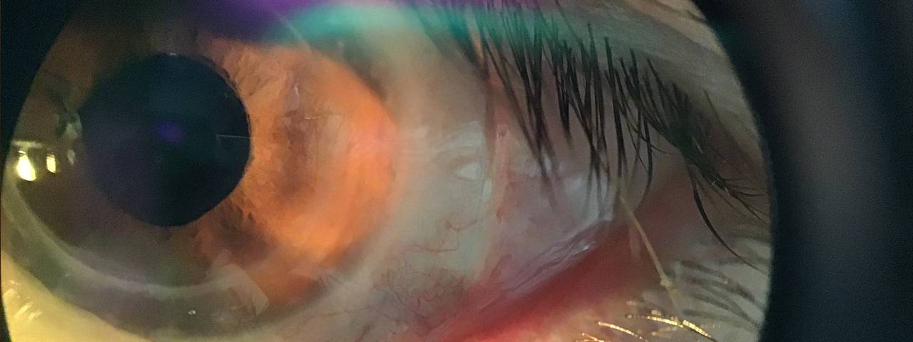bleeding red eyes, Optometrist in Fort Lauderdale, FL