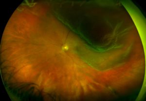 California Retinal DetachmentRetinalHolesTearsDetachments3