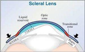 scleral lens