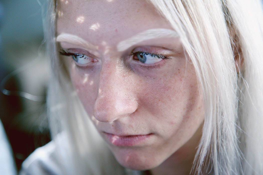 Girl with Albinism and Poor Eyesight