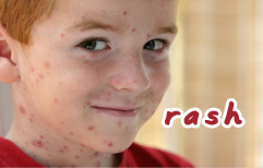 English Lesson - Chicken Pox