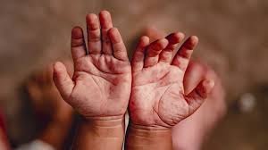 Throwing Up with Hand, Foot, and Mouth Disease: Is It Normal? Throwing Up with Hand, Foot, and Mouth Disease: Is It Normal?