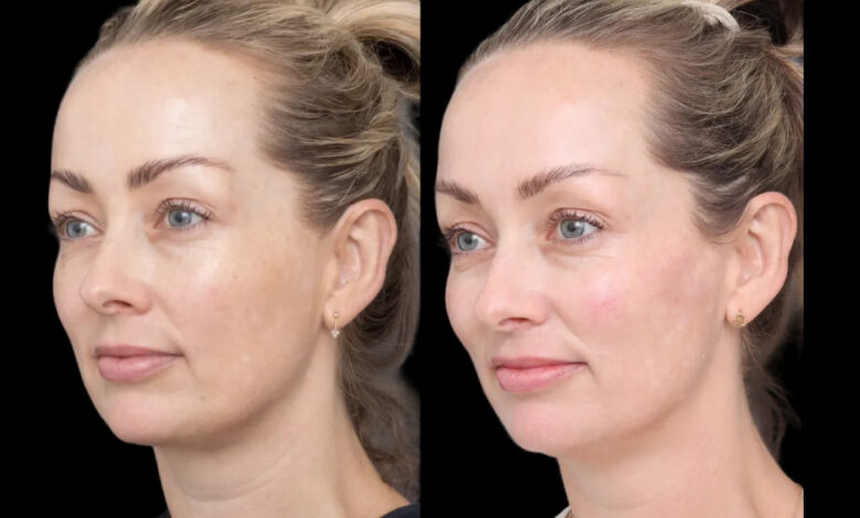 Cheek Fillers: Why the Best Aesthetic Clinic in Dubai Makes All the Difference Cheek Fillers: Why the Best Aesthetic Clinic in Dubai Makes All the Difference