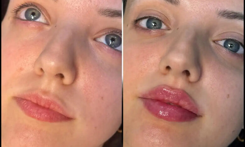 Enhance Your Fillers Features with the Best Aesthetic Clinic in Dubai Enhance Your Fillers Features with the Best Aesthetic Clinic in Dubai