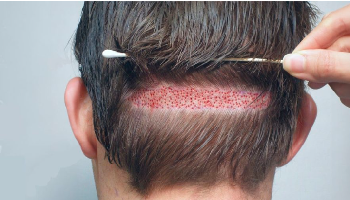 Hair Transplant in Pakistan for Men and Women: What’s Different? Hair Transplant in Pakistan for Men and Women: What’s Different?
